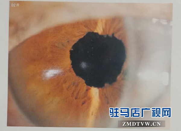 脫貧后，患眼疾20多年重見(jiàn)光明