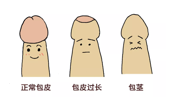 暑假要不要帶孩子去割包皮？這3種情況真得去醫(yī)院 