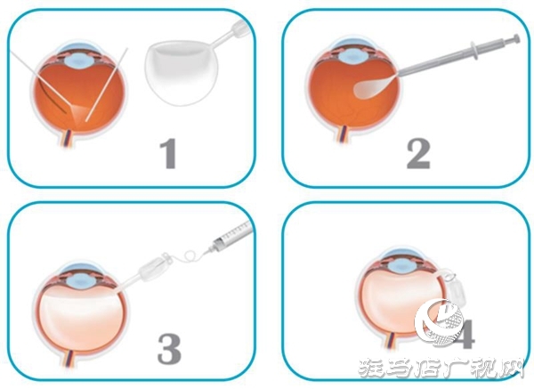 新技術(shù)！駐馬店市首例人工玻璃體球囊在駐馬店眼科醫(yī)院成功手術(shù)！
