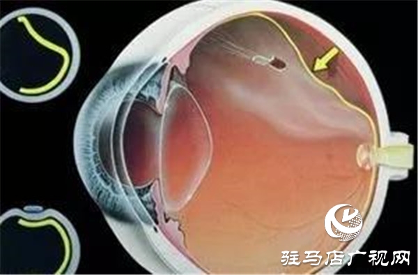 一只眼睛視網(wǎng)膜脫落，另一只也會脫落嗎