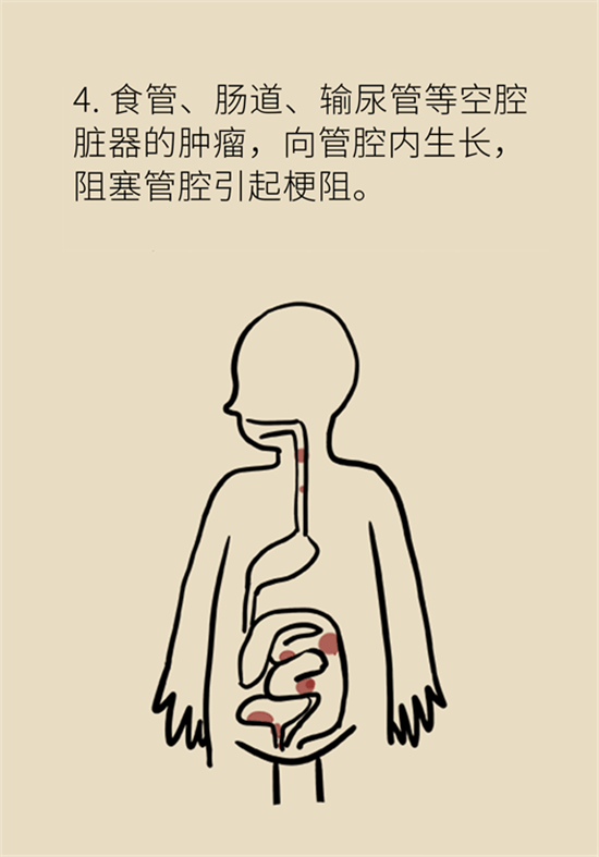 癌癥到底有多痛？需要注意這7個重點問題