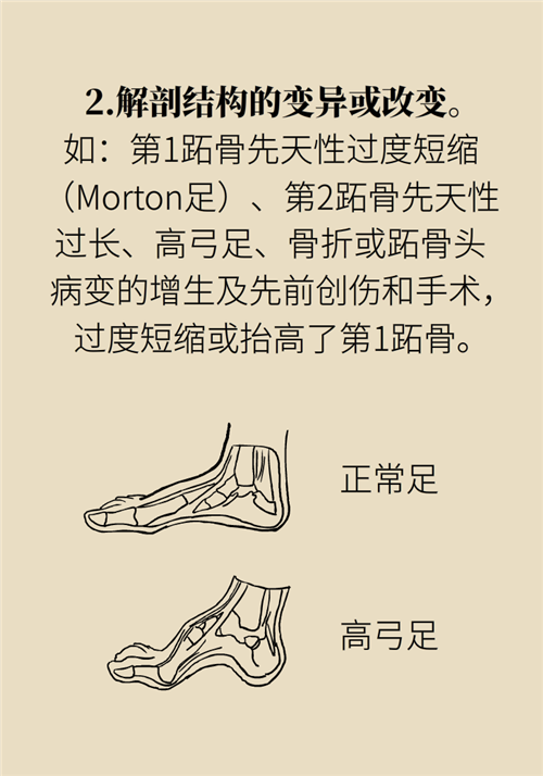 前腳掌起老繭并疼痛？當(dāng)心這可能是跖痛癥