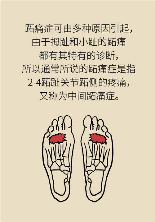 前腳掌起老繭并疼痛？當(dāng)心這可能是跖痛癥