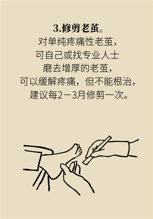 前腳掌起老繭并疼痛？當(dāng)心這可能是跖痛癥