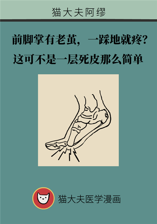 前腳掌起老繭并疼痛？當(dāng)心這可能是跖痛癥