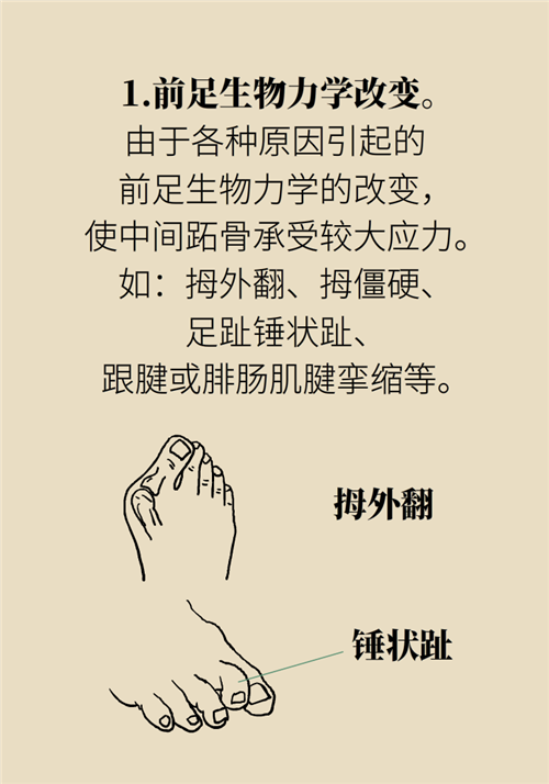 前腳掌起老繭并疼痛？當(dāng)心這可能是跖痛癥