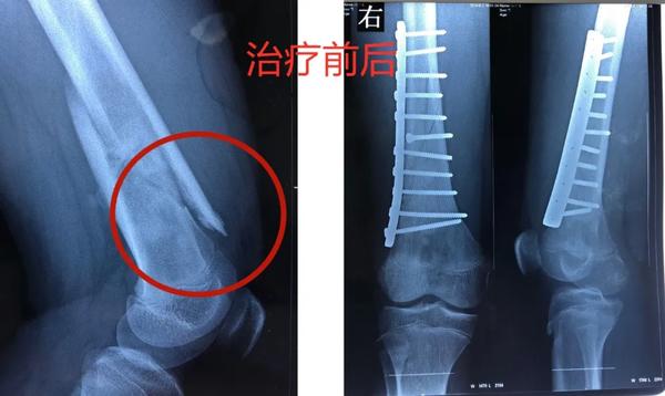 兒童這種“骨折”要警惕，可能是癌癥的預(yù)警信號