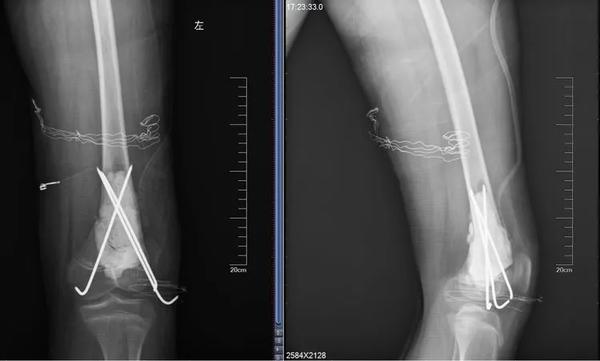 兒童這種“骨折”要警惕，可能是癌癥的預(yù)警信號