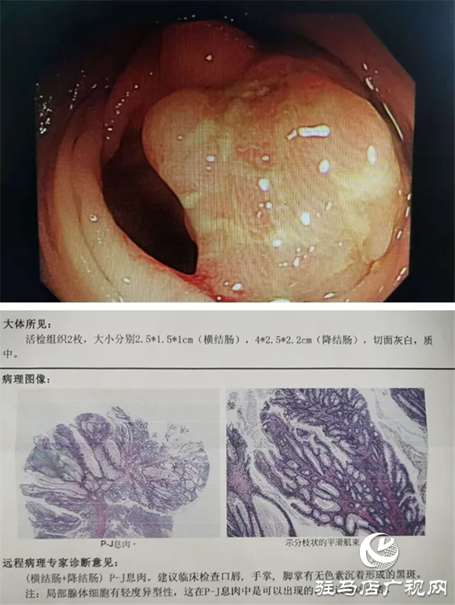 “黑痣”長(zhǎng)在嘴上，息肉生在腸內(nèi)！市中心醫(yī)院專家為一罕見病患者內(nèi)鏡下切除30多處腸道腫物