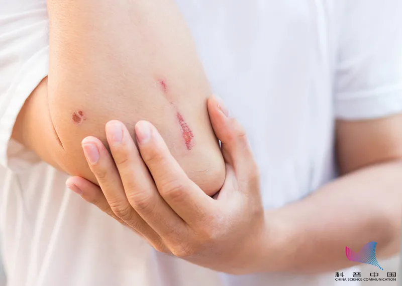 警惕！小傷口千萬(wàn)別不當(dāng)回事，嚴(yán)重可致命！趕緊告訴家里人