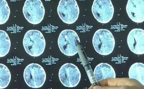 中國科學家揭示腦出血后神經(jīng)炎癥“元兇” 有望據(jù)此開發(fā)新型藥物