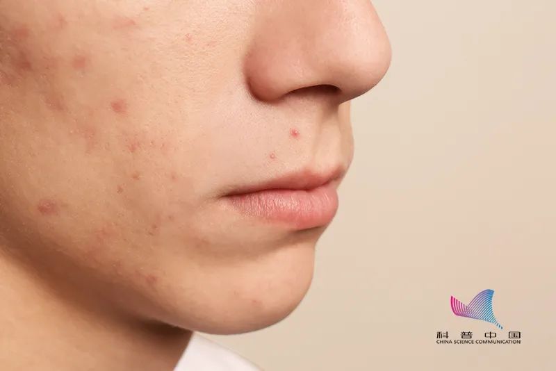 青春痘要有疫苗了！真的能預(yù)防青春痘嗎？成年人能不能接種？答案來了