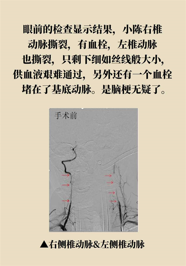 這個動作讓多名年輕人中風了，一定要重視！