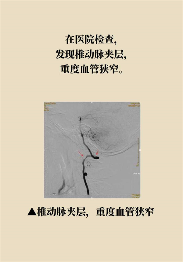 這個動作讓多名年輕人中風了，一定要重視！