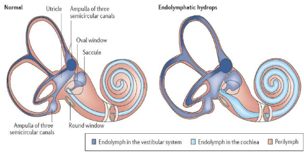 “耳水不平衡”是什么??？