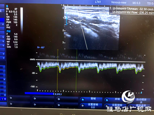 市內(nèi)首例!內(nèi)瘺上臂段覆膜支架植入打通透析&ldquo;生命線&rdquo;
