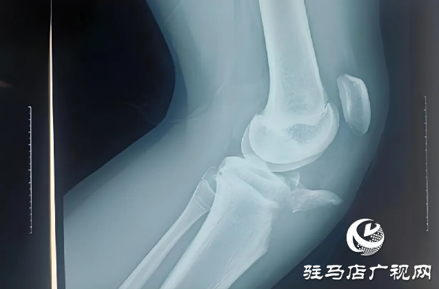 青少年運動時需注意脛骨結(jié)節(jié)撕脫性骨折