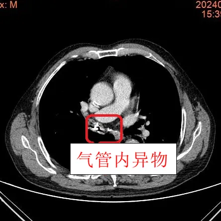 古稀老人“肺都要咳出來了” 竟是因為支氣管里“長”牙?