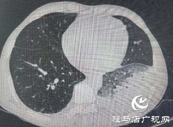 高燒不退、大面積肺炎 不是甲流不是感冒 “元兇”竟在家中！