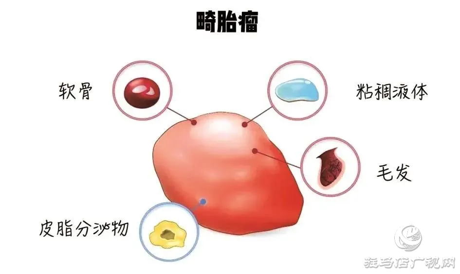 百聞不如一見！14歲少女“身懷怪胎”?