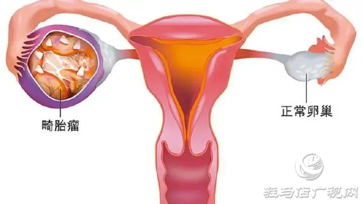 百聞不如一見！14歲少女“身懷怪胎”?