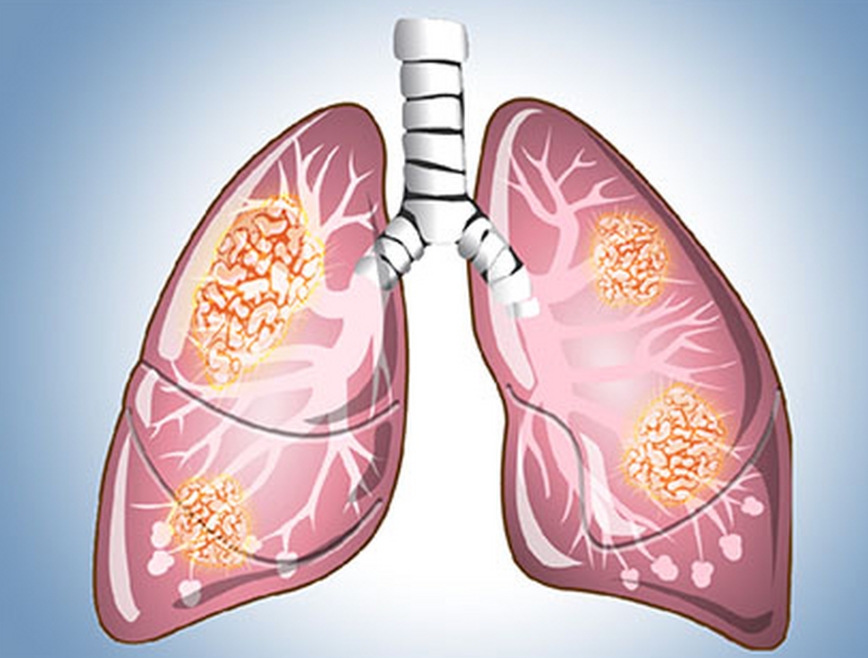 看見肺結節(jié)背后的“真相”