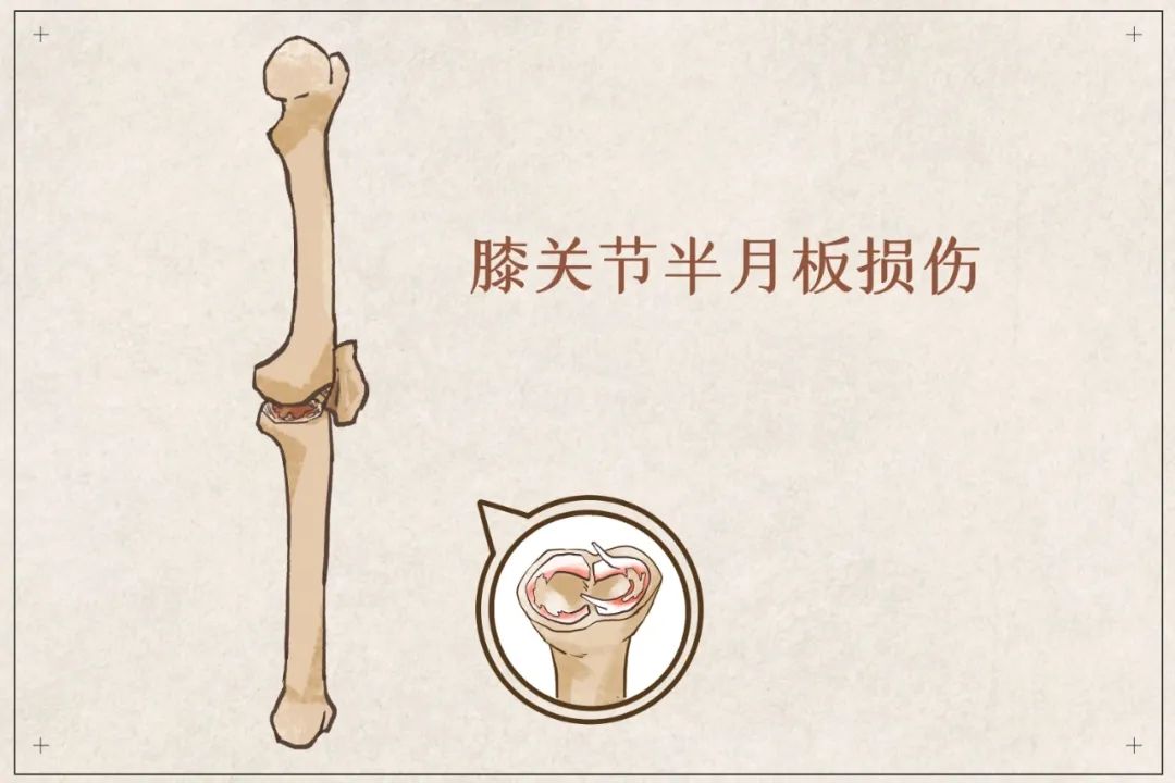 盲目鍛煉？你的半月板傷不起