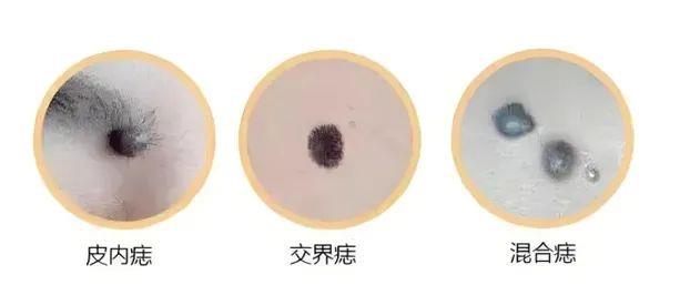 危險的痣長啥樣？“ABCDE法則”教你辨別