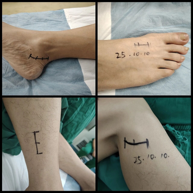 腦外科成功開展周圍神經(jīng)減壓術(shù)，為糖尿病患者解除病痛困擾