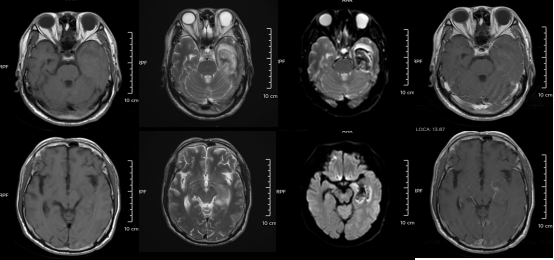 30歲小伙長期熬夜智力退回3歲 年輕人患“腦膜炎”病例為何頻發(fā)？