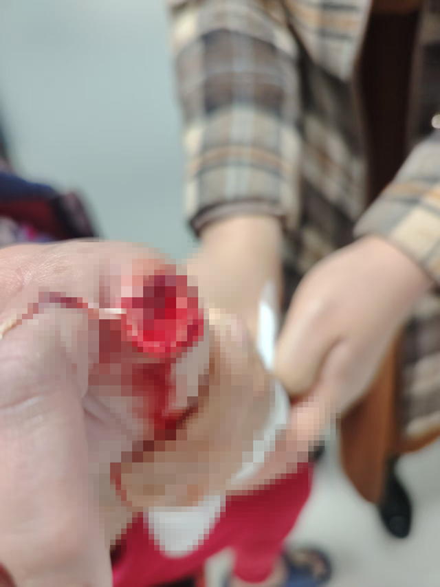 自家寵物犬突然發(fā)狂咬斷主人手指 專家提醒犬傷處置切勿拖延