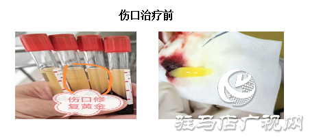 【新技術】PRF自體修復技術喚醒傷口自愈力 快愈無痕更舒心