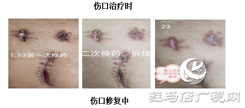 【新技術】PRF自體修復技術喚醒傷口自愈力 快愈無痕更舒心