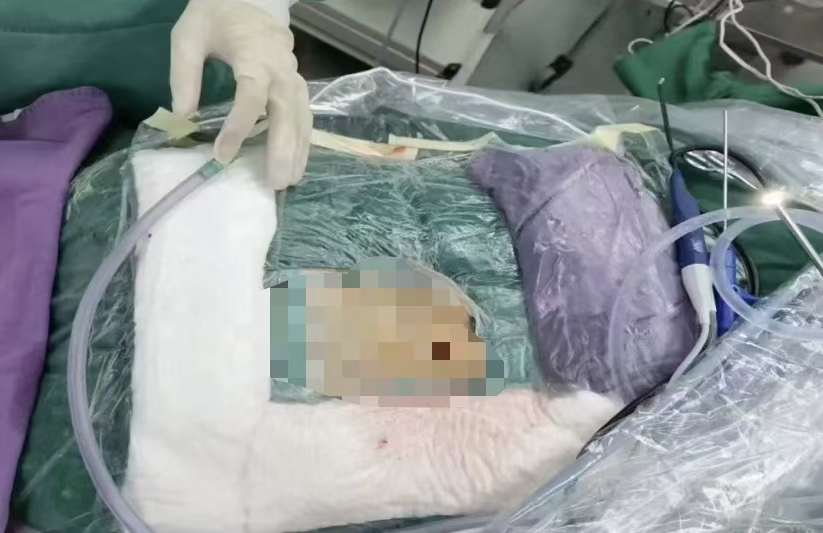 駐馬店市中醫(yī)院成功實(shí)施UBE微創(chuàng)手術(shù)，助腰腿痛患者重獲健康