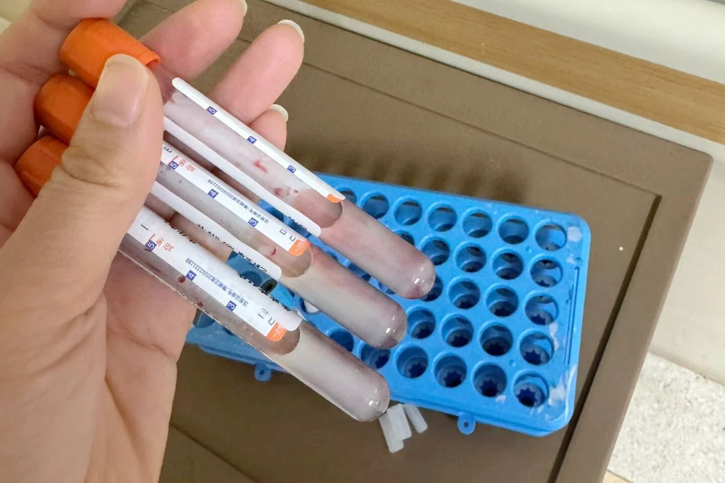 駐馬店一女子吃油炸食品，致甘油三酯超標(biāo)34倍，竟抽出奶白色血液！