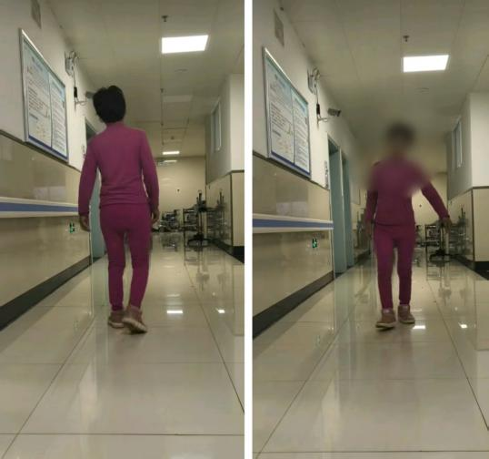 假體松動(dòng)不用愁！髖關(guān)節(jié)翻修術(shù)為患者重啟穩(wěn)固人生