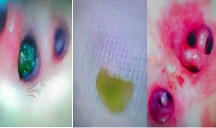 險！葡萄果肉堵塞氣道，駐馬店市中醫(yī)院兒科上演鏡下 &ldquo;拆彈&rdquo;